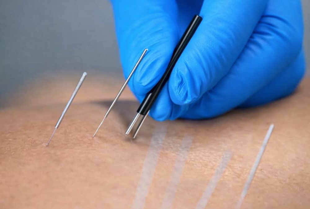 needling